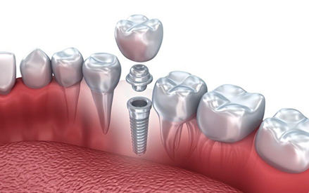 The development prospects of medical detal titanium materials.